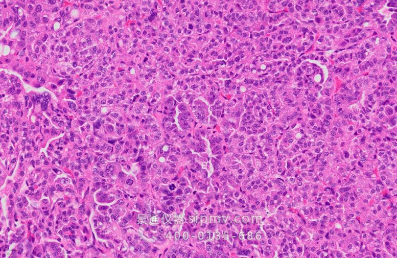 肺腺癌的组织学染色