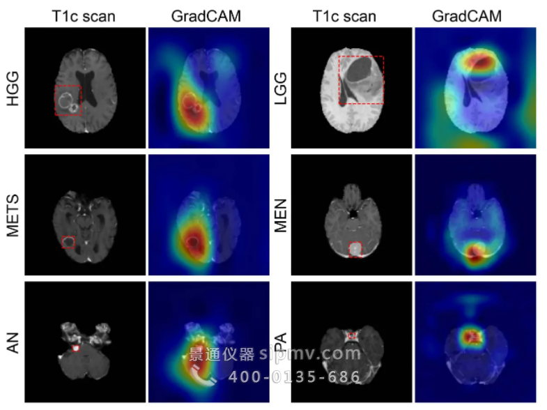 深度学习模型通过单次MRI扫描对脑肿瘤进行分类