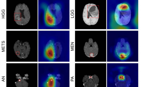 人工智能通过单次MRI扫描对脑肿瘤疾病进行分类